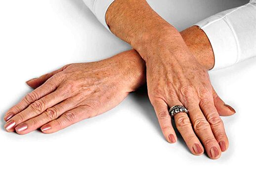 Hand skin with age-related changes that require the use of rejuvenating techniques