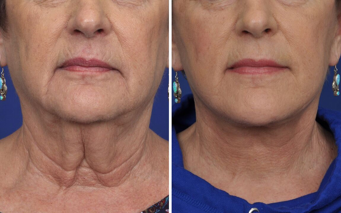 before and after skin rejuvenation procedure
