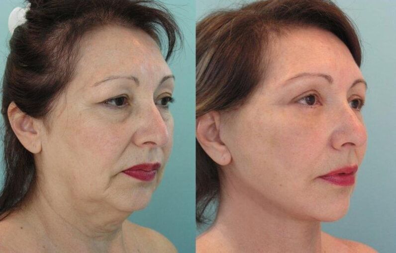 The results of facial skin rejuvenation and tightening with threads