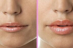 before and after lip restoration procedures