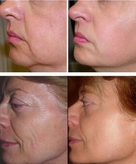 photos before and after laser shard rejuvenation